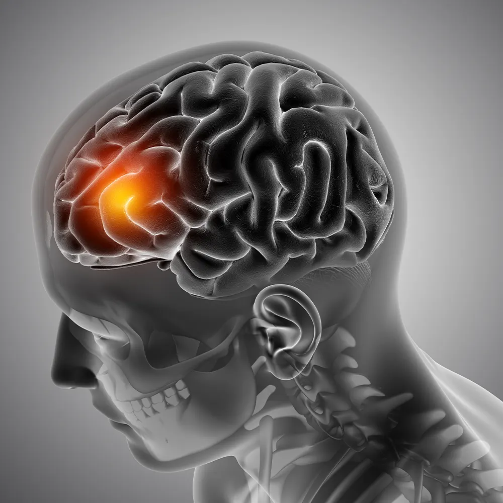 Neurological physical therapy focused on improving strength, balance, mobility, and daily function following stroke or other neurological conditions through personalized rehabilitation care.