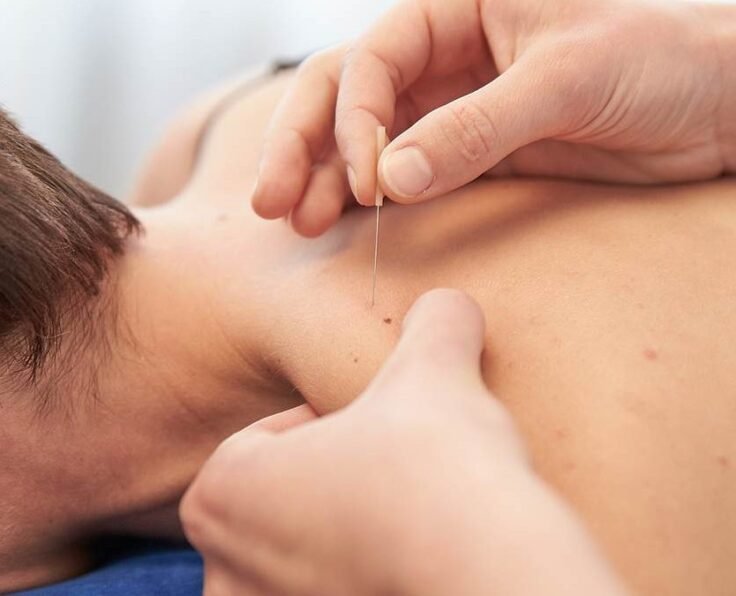 Dry-Needling-900x675-1